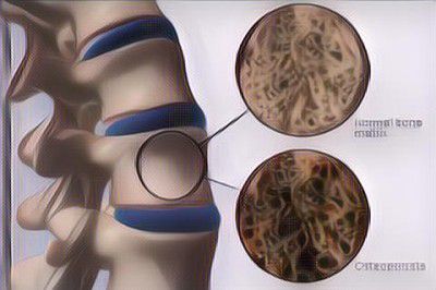 Wajib Tahu! 7 Kebiasaan Buruk Ini Bisa Merusak Tulang