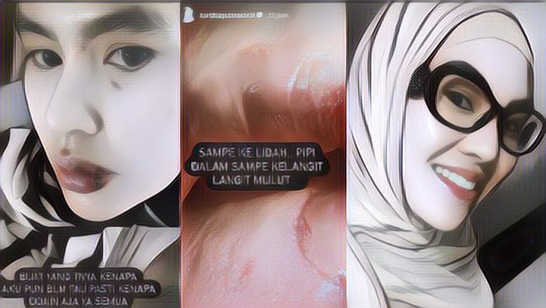 Kartika Putri Alami Kondisi Wajah yang Mengerikan Akibat Alergi, Netizen: Kena Ain?