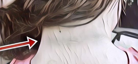 Jangan Diabaikan, Ternyata Leher Belakang Berwarna Hitam Bisa Jadi Pertanda Penyakit Serius, Ini Faktanya