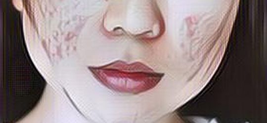 Cara Mengatasi Jerawat pada Kulit Remaja, Jangan Asal Pakai Obat!