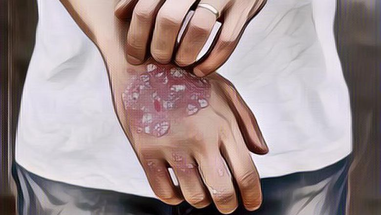 Apa Itu Psoriasis Vulgaris? Mengenal Lebih Dekat Masalah Kulit yang Sering Diabaikan