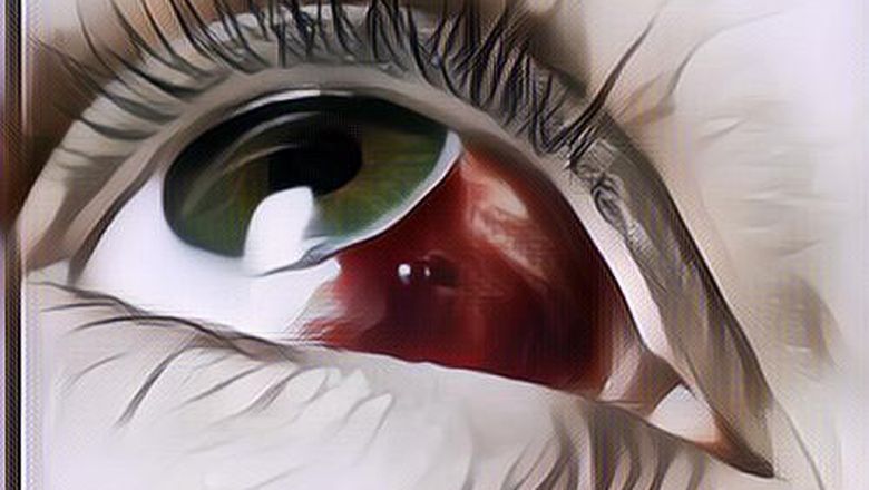 Mata Merah Sebelah: Begini Penyebabnya Gengs