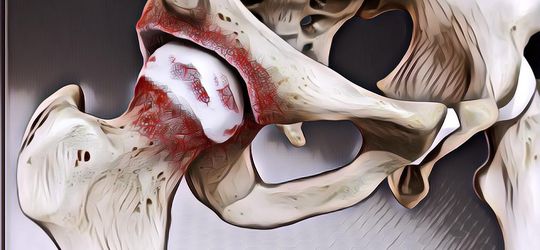 5 Gejala Osteoarthritis yang Paling Umum