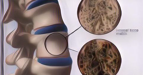 Wajib Tahu! 7 Kebiasaan Buruk Ini Bisa Merusak Tulang