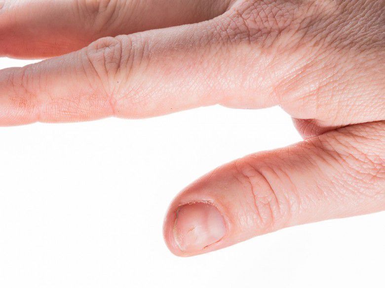 6. Kuku menebal dan berbintik putih