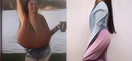 Kasihan, Wanita Ini Idap Penyakit Tak Umum, Payudaranya Terus Tumbuh Hingga 10 Kg