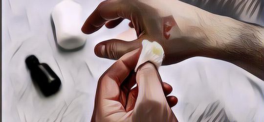 Bukan Pakai Odol! Ini Cara Mengobati Luka Bakar Ringan yang Benar di Rumah