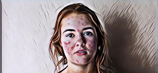 Mitos dan Fakta Seputar Jerawat, Penyebabnya Bukan Cuma Karena Wajah yang Kotor Kok!