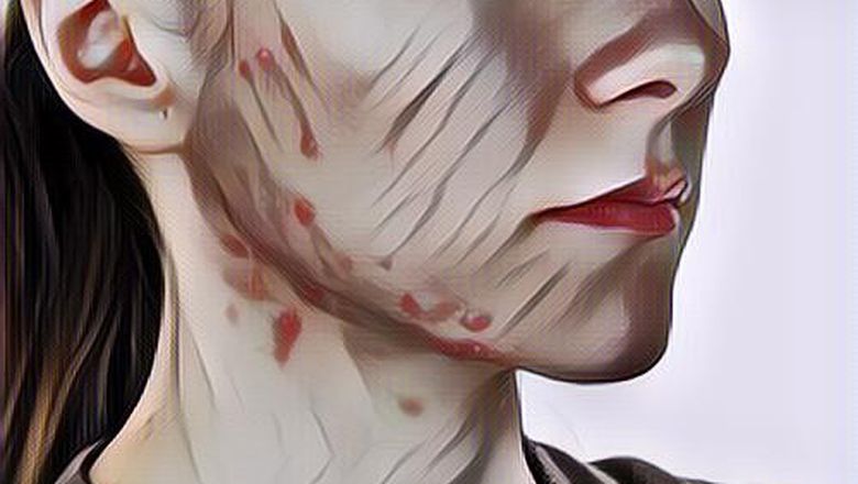 Mengenali Jenis-Jenis Jerawat Yang Biasa Muncul Di Wajah… Ternyata Beda-Beda Banget!