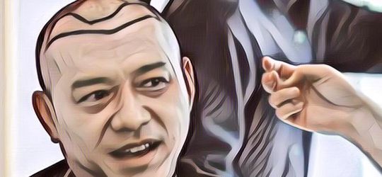 Anang Hermansyah Lakukan Transplantasi Rambut: Ampuhkah Atasi Kebotakan?