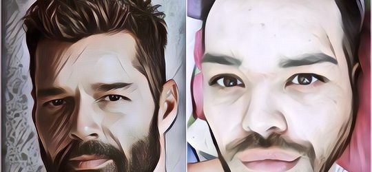 Demi Bisa Mirip Ricky Martin, Pria Ini Malah Nekat Injeksi Oli ke Wajahnya