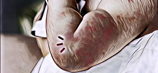 Waspada! Ruam Kulit Bisa Jadi Tanda 5 Penyakit Serius Lho, Apa Aja?