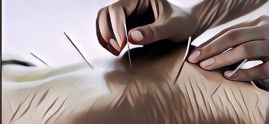 Akupuntur Jadi Salah Satu Cara Menurunkan Kolesterol, Begini Penjelasan Ahli