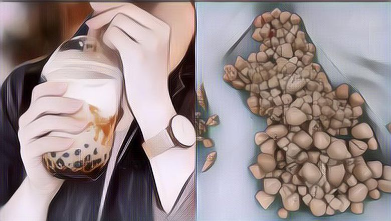Miris! Wanita Punya 300 Batu Ginjal Di Tubuhnya, Terungkap Penyebabnya Karena Bubble Tea