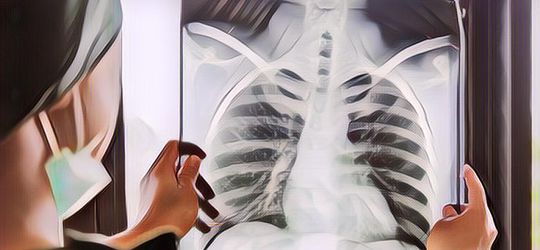 Mengenal Apa Itu Penyakit Bronkitis yang Diderita Anak Zaskia Mecca dan Hanung Bramantyo