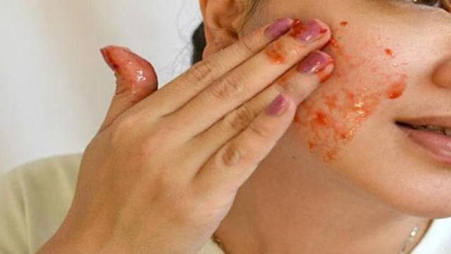 6. Mengatasi Jerawat