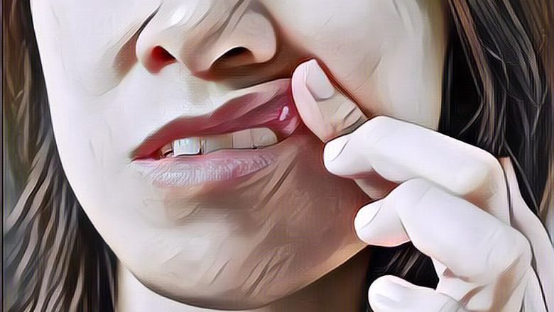 Ketahuilah Ciri Sariawan yang Bisa Jadi Itu Menandakan Kanker Mulut