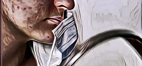 Sering pakai Masker Bikin Jerawatan di Pipi? Ini Cara Mencegahnya