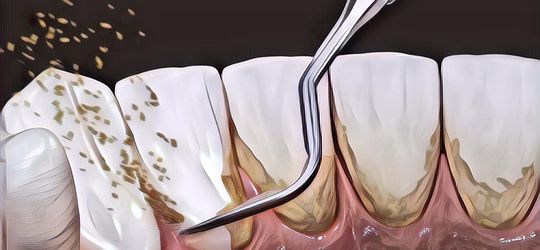 Bersihkan Karang Gigi Sendiri dengan 4 Bahan Natural Ini! Ampuh Banget!