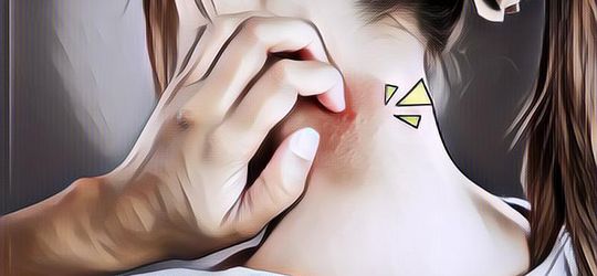 Apa Itu Dermatitis Seboroik yang Kerap Membuat Kulit Gejala Kulit Bersisik, Kemerahan, dan Ketombe?
