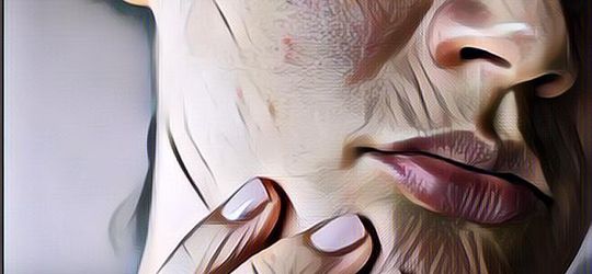 Pria Ini Ngeluh Soal Bintik-Bintik di Wajahnya, Langsung Dituduh Kena Sifilis