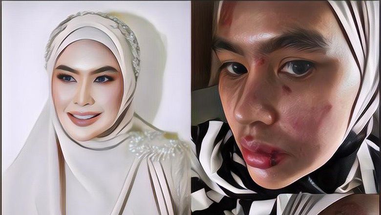 Kartika Putri Ungkap Kronologi Seluruh Wajahnya Tiba-Tiba Melepuh, Bantah Tuduhan Kena Karma