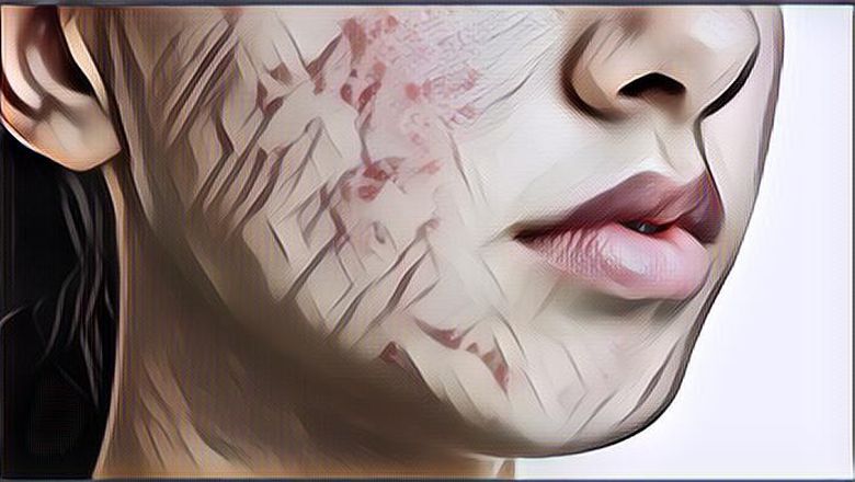 Kebiasaan Sepele yang Sering Kita Lakukan Di Rumah Ini Bisa Bikin Jerawat Tumbuh dan Susah Hilang!