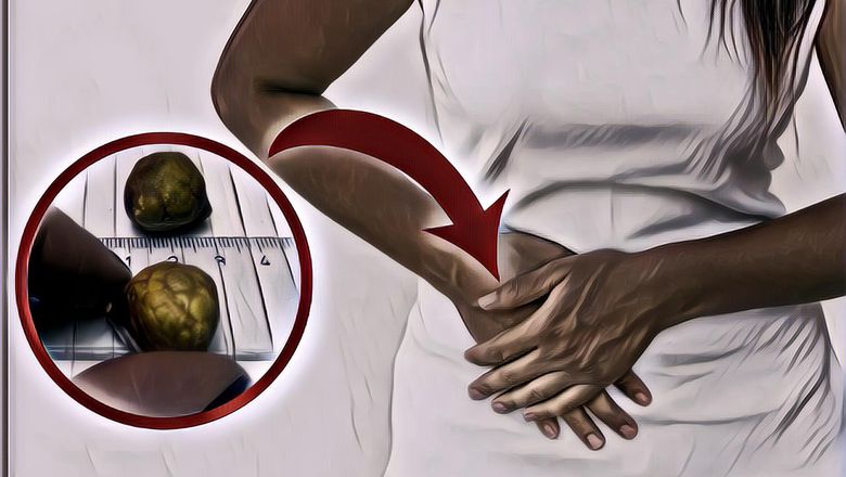 5 Cara Alami Sembuhkan Batu Empedu, Mau Coba?