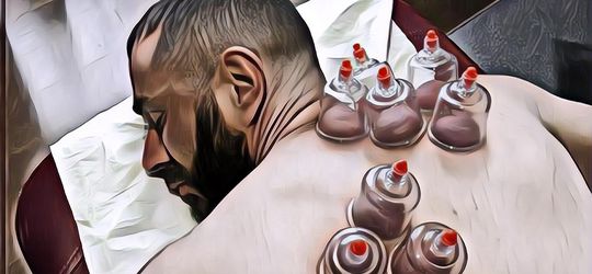 8 Manfaat Terapi Bekam yang Mungkin Belum Kamu Tahu