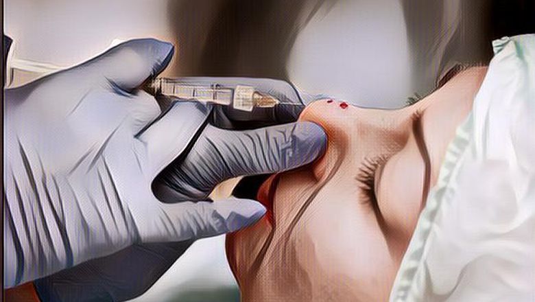 Mengenal Filler Hidung, Treatment Kecantikan yang Dilakukan Kekeyi