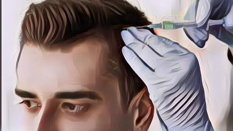 Kenalan dengan Istilah Cangkok Rambut Seperti yang Dilakukan Kevin Aprilio