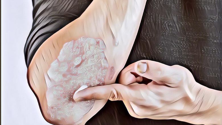 5 Makanan yang Mempengaruhi Psoriasis, Penyakit Autoimun Kronis