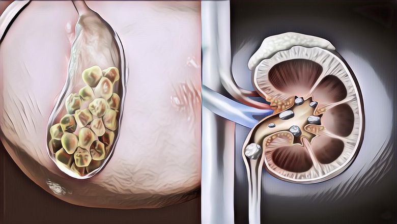 5 Cara Alami Menyembuhkan Batu Empedu, Lebih Hemat dan Tanpa Sakit