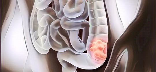 Mengenal Apa itu Kanker Kolorektal, Penyakit Mematikan yang Jadi Salah Satu Penyebab Kematian Terbesar