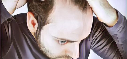 Ternyata Ini Penyebab Kenapa Pria Rentan Alami Kebotakan