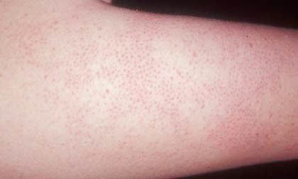 5.  Bintik-bintik di lengan belakang