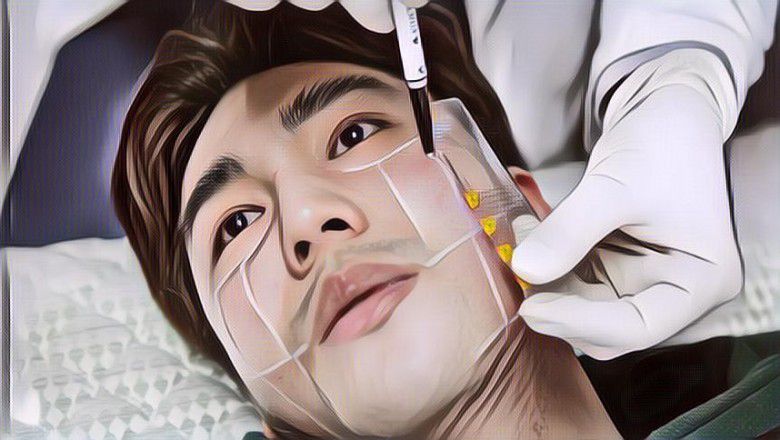 Oplas Bagi Kaum Lelaki, Lebih Mudah Dipercaya