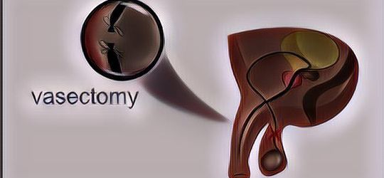 Mengenal Apa Itu Kontrasepsi Vasektomi yang Bisa Dilakukan Pria Sekali Saja Seumur Hidup