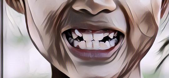 Penjelasan Medis Kenapa Balita Dilarang Pakai Behel, Orangtua Wajib Baca!