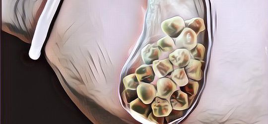 5 Cara Menyembuhkan Batu Empedu dengan Alami, Bisa Lebih Murah