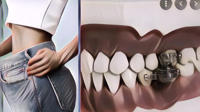 Unik Banget, Ada Alat Diet Magnet Yang Dipasang Ke Gigi Supaya Gak Makan Banyak