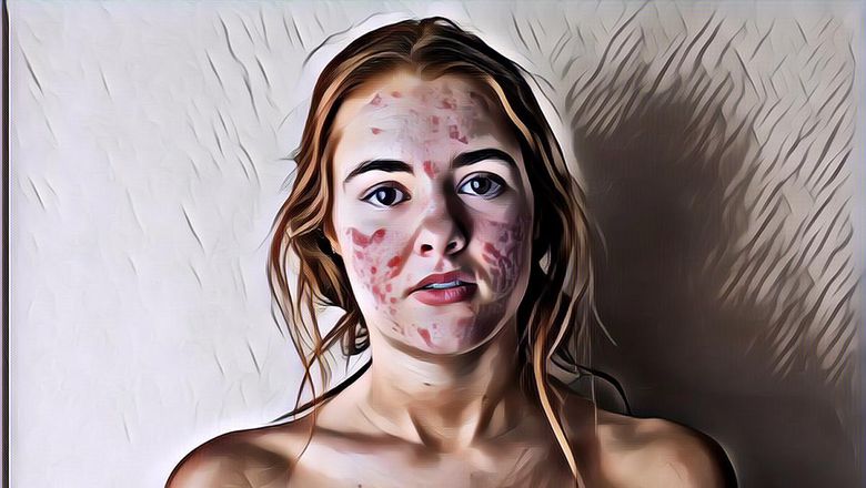 Mitos dan Fakta Seputar Jerawat, Penyebabnya Bukan Cuma Karena Wajah yang Kotor Kok!