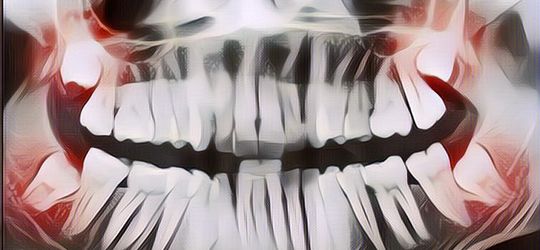 Mengenal Fungsi Gigi Bungsu yang Kadang Masih Tumbuh Ketika Kita Dewasa, Kenapa Seringkali Harus Dicabut?