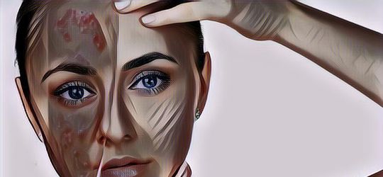 Obat Jerawat Batu di Apotek, Kamu Gak Usah Bingung Lagi...