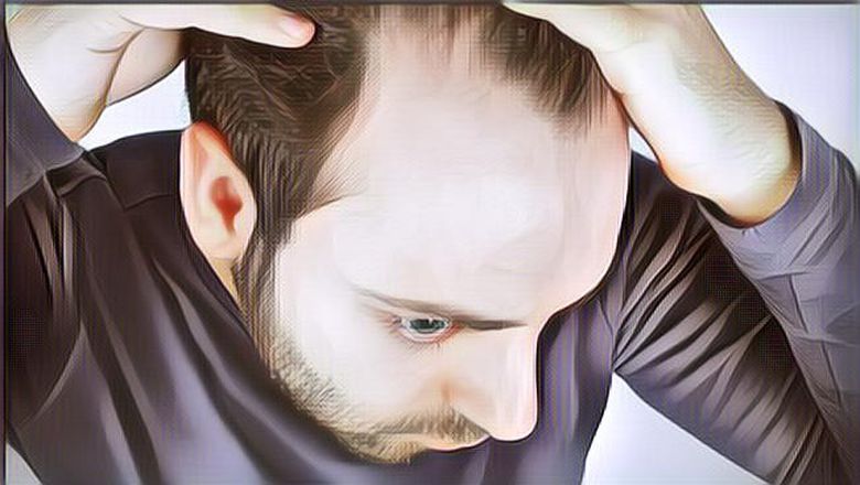 Ternyata Ini Penyebab Kenapa Pria Rentan Alami Kebotakan